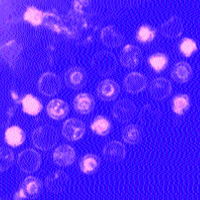 Mononucleosi_fig2