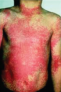 Streptococcinum_2012-fig3